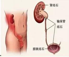输尿管结石可以吃葫芦瓜,天然食疗的神奇功效